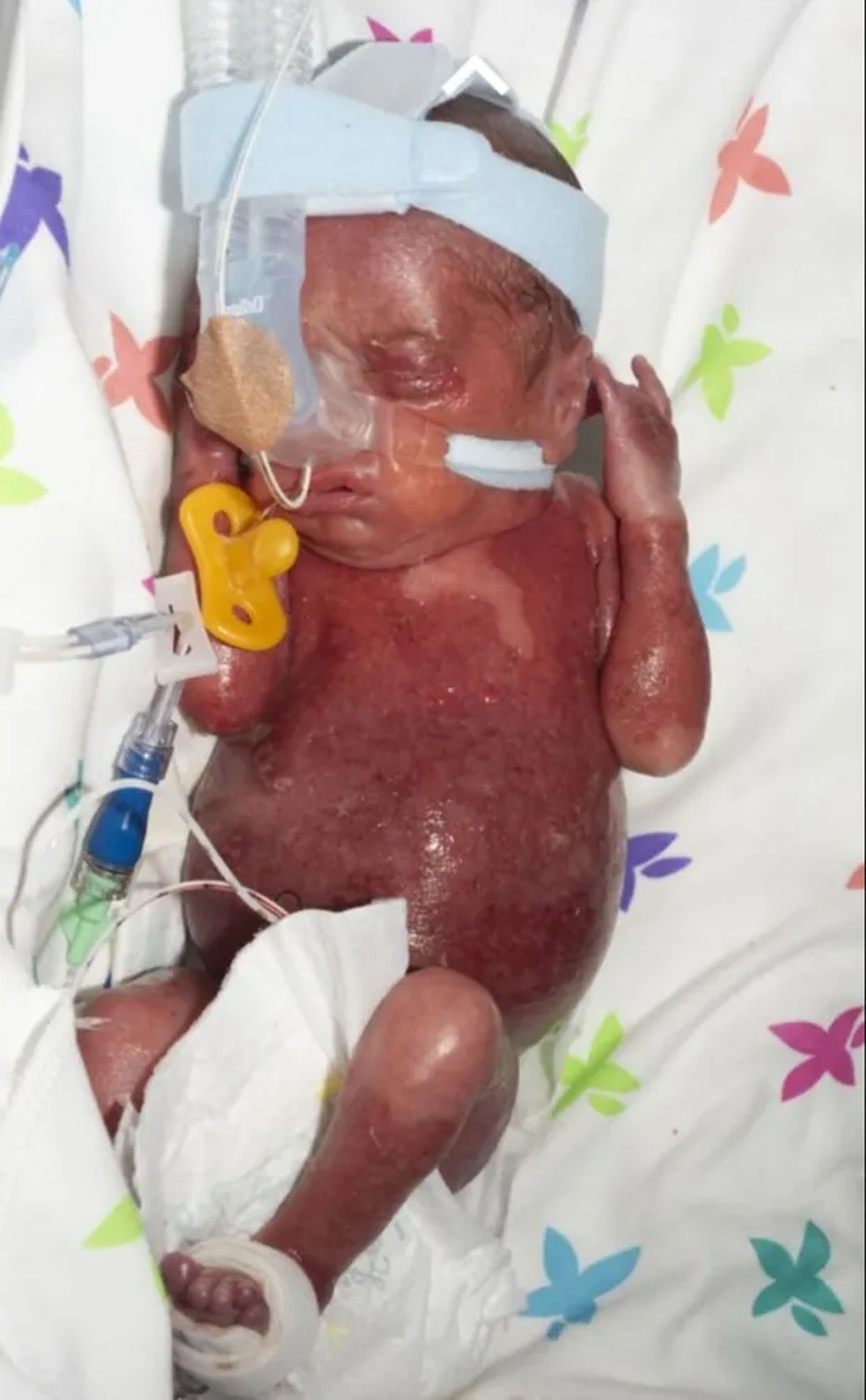 Luca precisou de cuidados intensivos imediatos e foi colocado em um saco pl&aacute;stico para manter sua temperatura corporal. &mdash; Foto: Reprodu&ccedil;&atilde;o