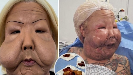 Quase 20 dias após cirurgia, Juju do Pix exibe recuperação e médico detalha avanço na retirada de óleo industrial