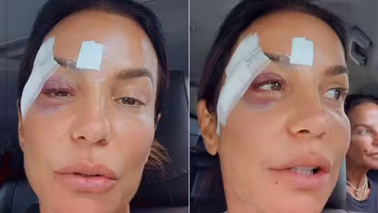 Ivete Sangalo anuncia cirurgia após desmaio e queda em casa