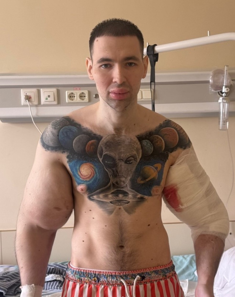 Kirill Tereshin, mais conhecido como 'Popeye russo', após cirurgia em um dos braços — Foto: Reprodução/Instagram