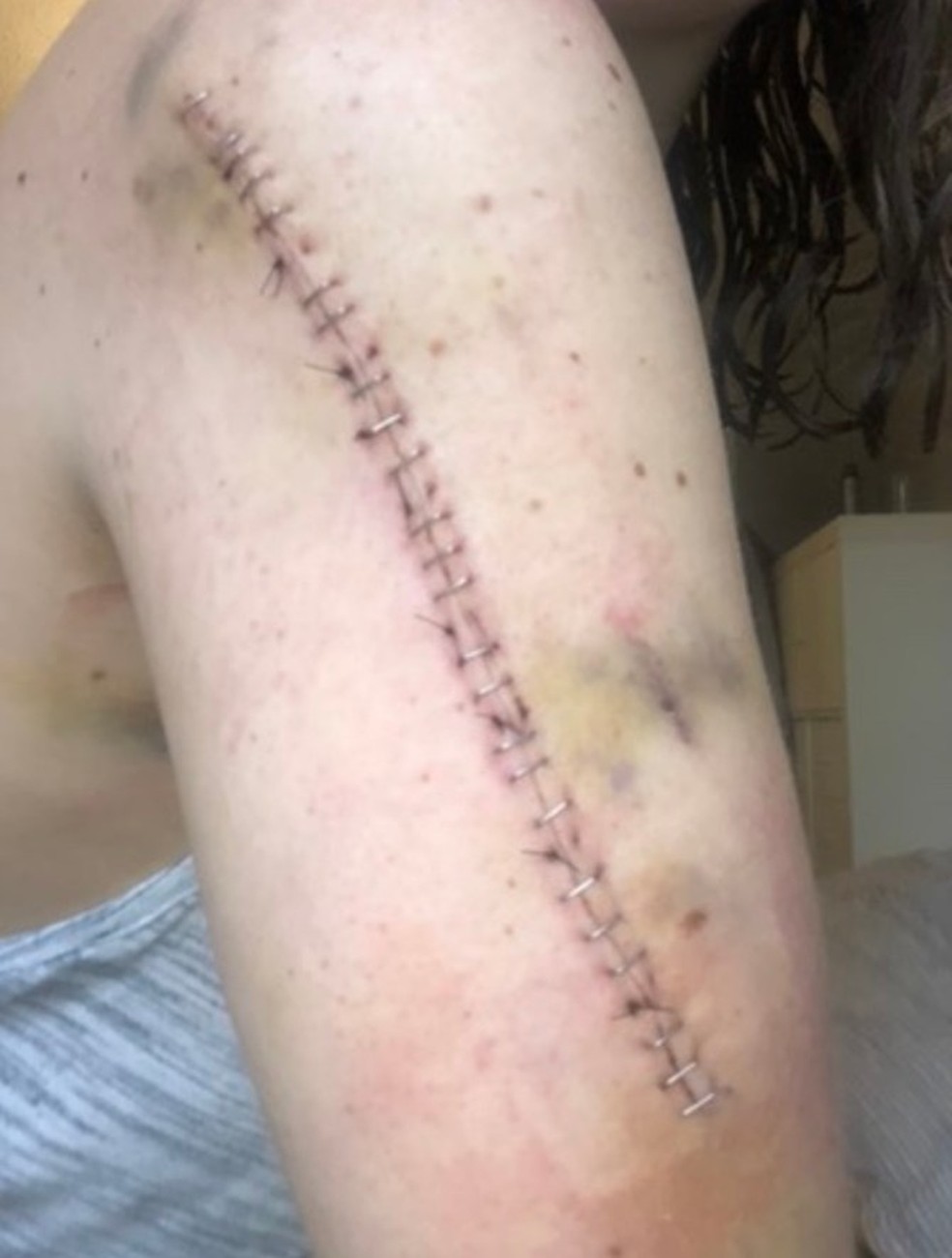 A cicatriz deixada após a cirurgia — Foto: Reprodução