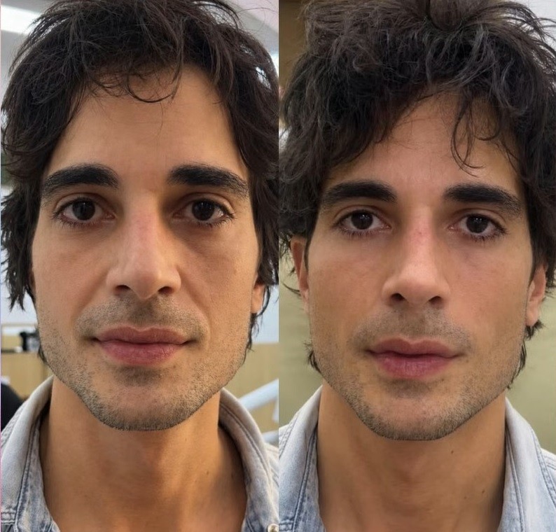 Fiuk passa por harmonização facial: veja antes e depois