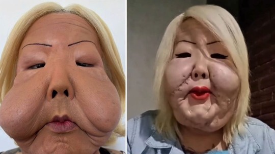 Quase um mês após cirurgia, Juju do Pix exibe rosto com recuperação promissora após retirada de óleo mineral