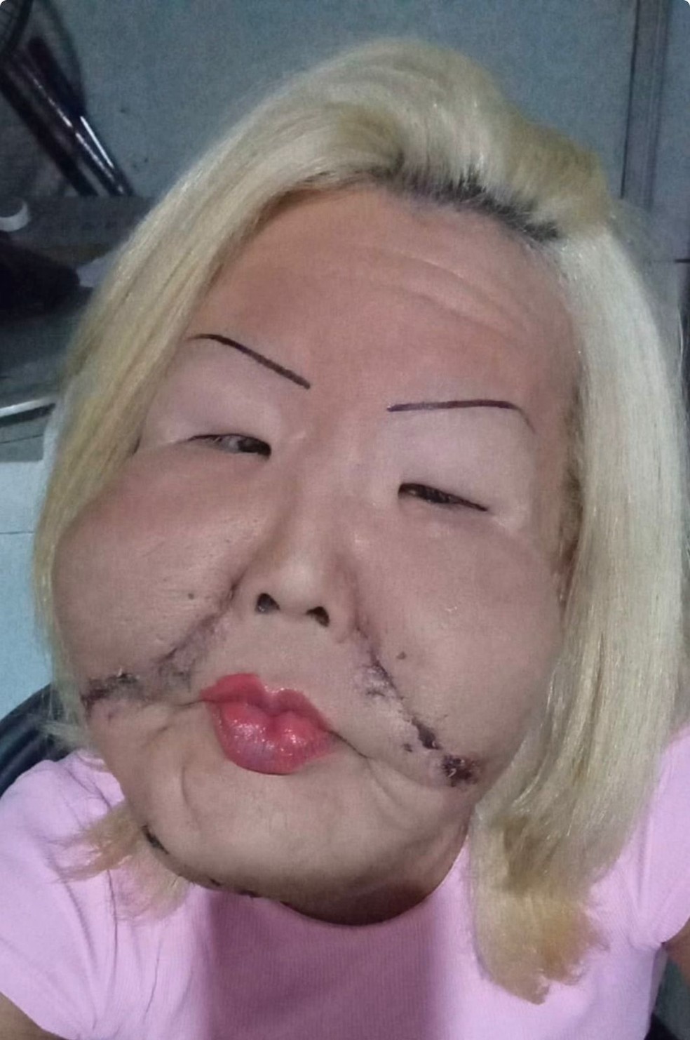 Juju do Pix mostra rosto, dez dias após cirurgia para retirar óleo industrial — Foto: Reprodução/Instagram