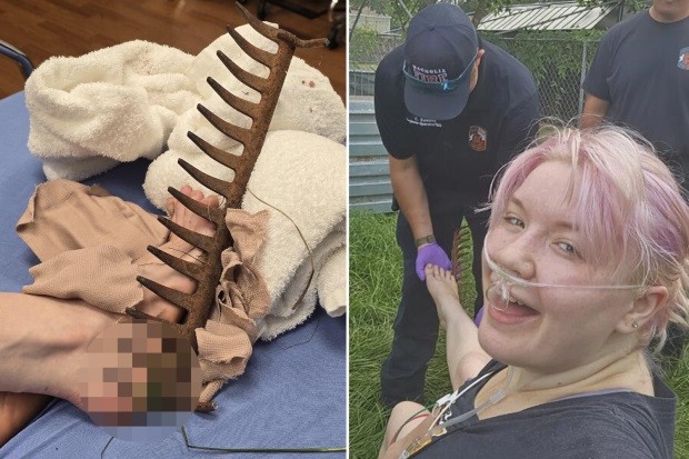 Mulher acaba com pé cravado em ancinho enferrujado ao caminhar descalça pelo jardim de casa com o filho - QTU Questões do Universo
