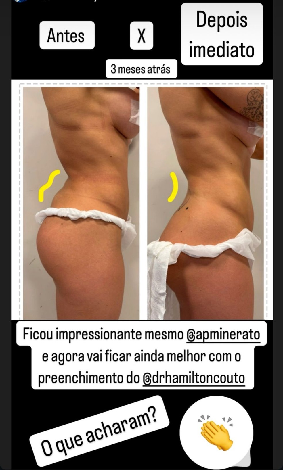 Ana Paula Minerato retira hidrogel do bumbum após complicações — Foto: Instagram