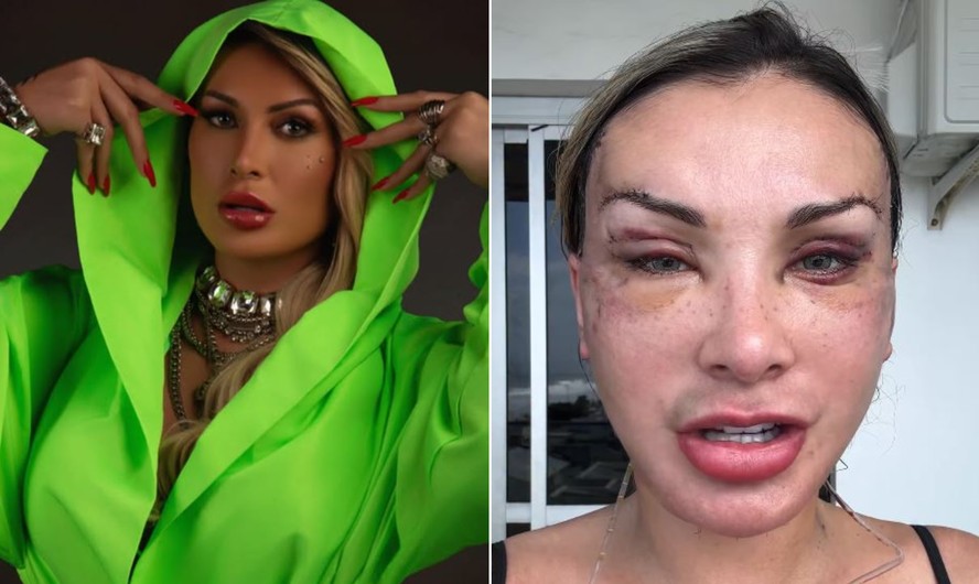 Andressa Urach se recupera de 50ª cirurgia: ela já fez retirada de costela e bifucação da língua