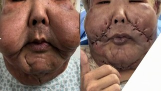 A trans Juju Fofão realizou a cirurgia para retirada do óleo mineral de seu rosto — Foto: Reprodução/Instagram