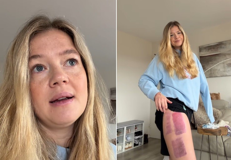 Mulher que perdeu antebraço em ataque de tubarão anuncia novo drama: enxerto de pele em coxa deu errado