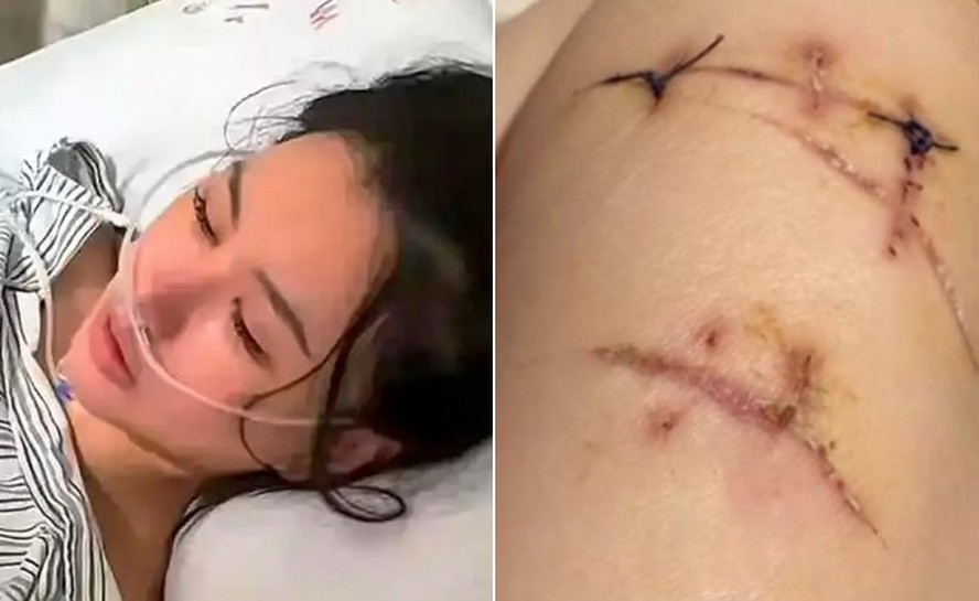 Chinesa golpeada com faca 22 vezes foi salva por próteses de silicone