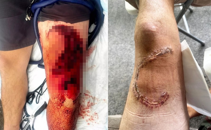 Pescador Josiah Kaimani Ventura tentou libertar tubar&atilde;o de rede, mas acabou brutalmente atacado