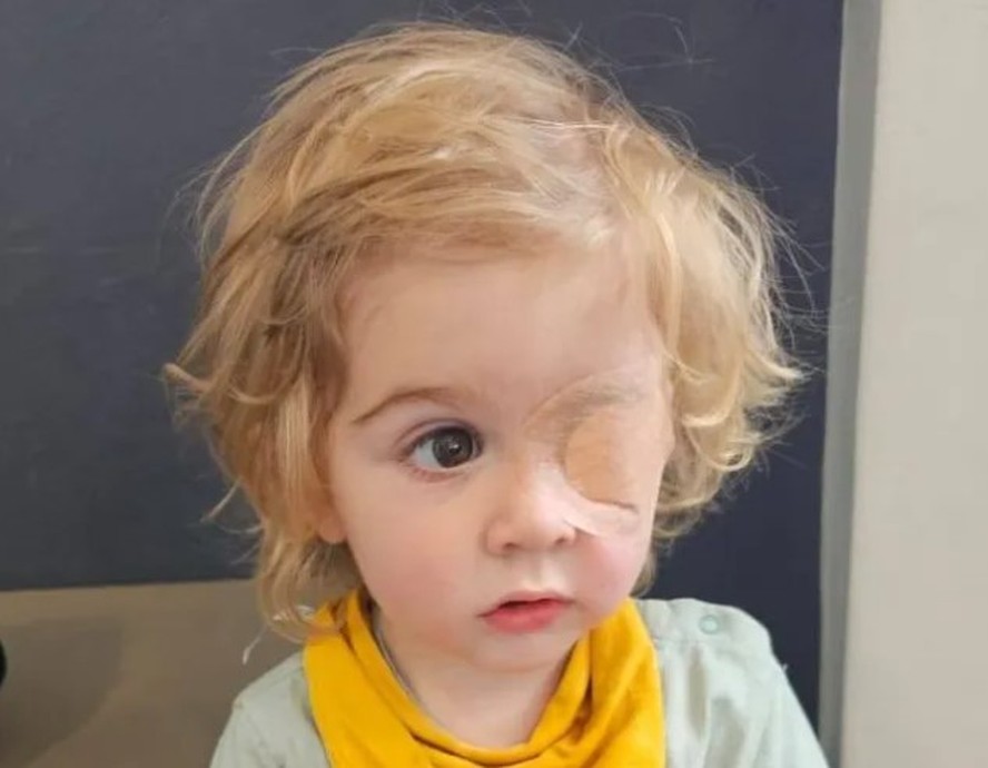 Menino perde a visão de um olho após ser beijado por pessoa com herpes labial