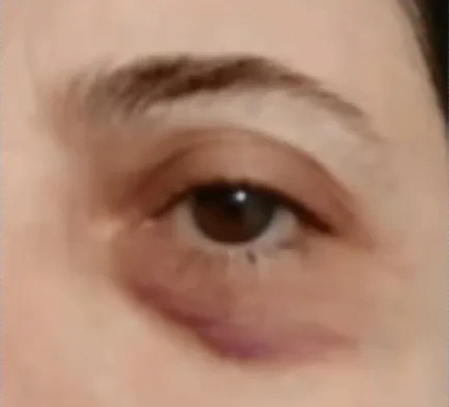 O olho da professora após a agressão sofrida por parte de um aluno