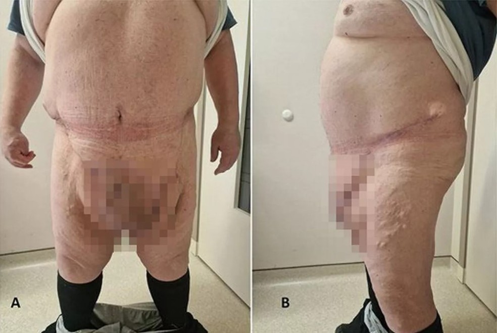 Paciente macedônio após a remoção de tumor abdominal de 35 quilos — Foto: Reprodução/Journal of Surgical Case Reports
