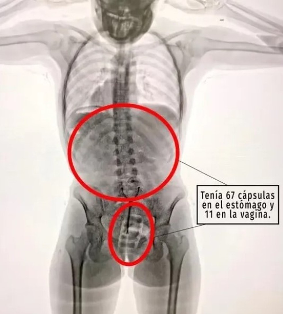 Jovem &eacute; presa ap&oacute;s ser flagrada no aeroporto de Ezeiza com 11 c&aacute;psulas com coca&iacute;na na vagina e outras 67 no est&ocirc;mago &mdash; Foto: Reprodu&ccedil;&atilde;o