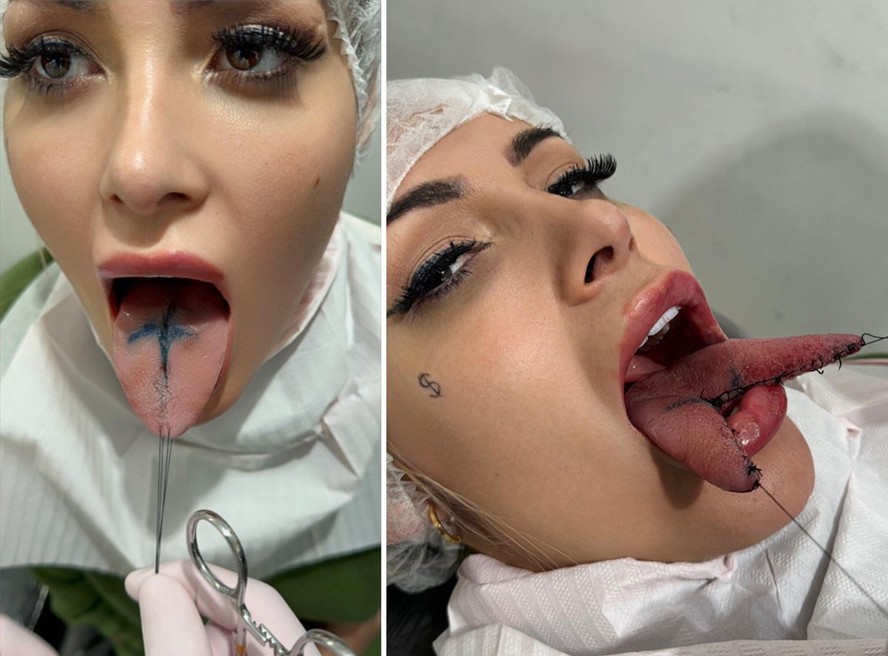 Andressa Urach faz procedimento de língua de cobra em busca de maior prazer