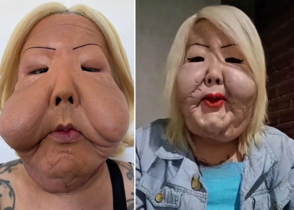 Juju do Pix mostra rosto, quase um mês após cirurgia para retirar óleo industrial — Foto: Reprodução/Instagram