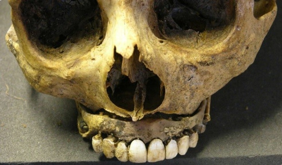 O "Sorriso de Waterloo"  refere-se a dentaduras feitas com dentes humanos reais, extraídos dos corpos de soldados mortos. — Foto: Reprodução/Facebook