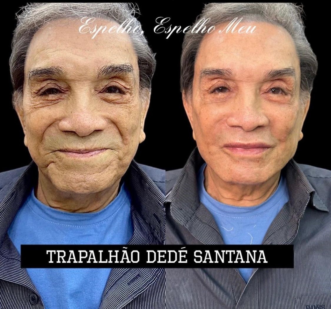 Ximbinha surpreende fãs em primeiro show após harmonização facial