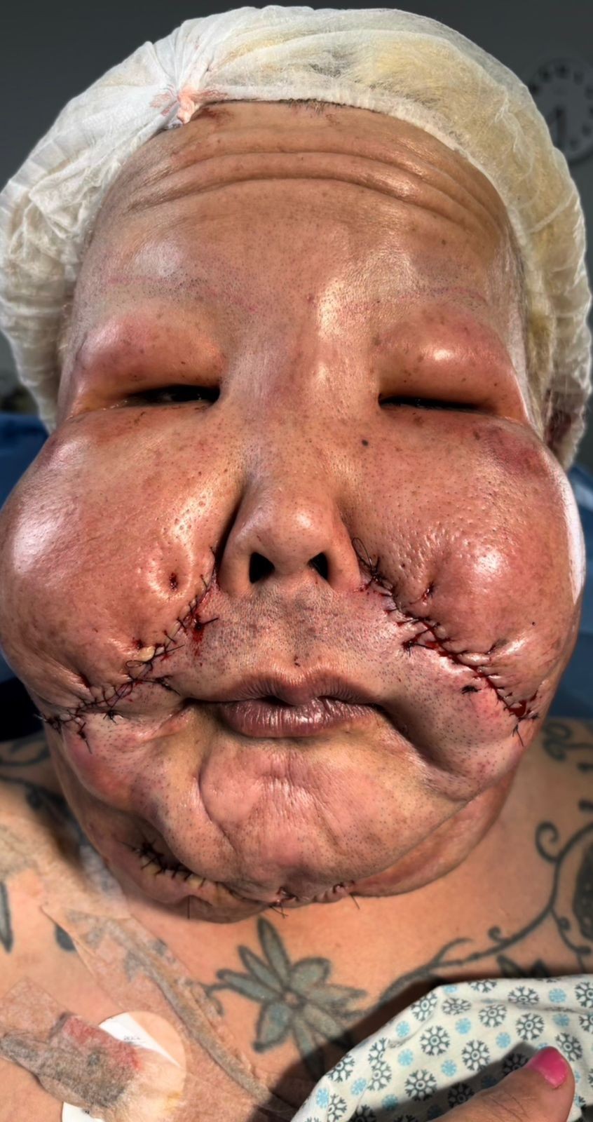 Juju do Pix passar&aacute; por nova cirurgia para retirar &oacute;leo mineral do rosto &mdash; Foto: Reprodu&ccedil;&atilde;o e Instagram