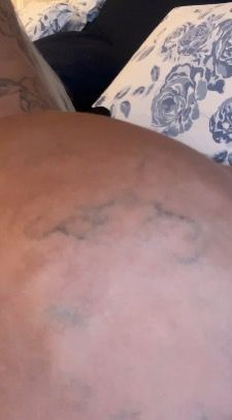 Juju Ferrari mostra como ficou o bumbum após infecção por hidrogel — Foto: Arquivo pessoal