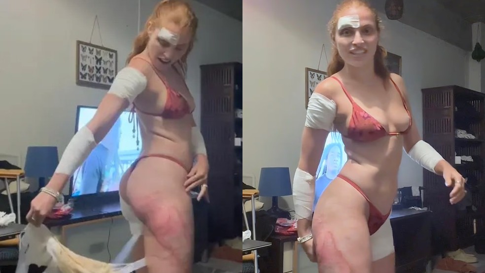 Jovem chegou a postar outro vídeo mostrando como ficou após o acidente — Foto: Reprodução