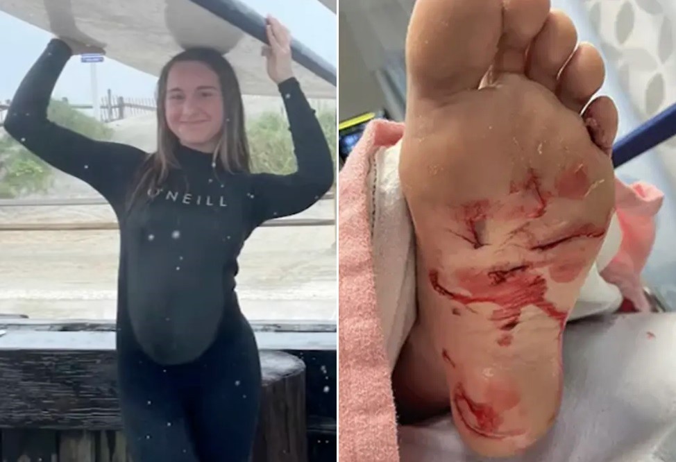 Maggie Drozdowski foi atacada por tubarão e acabou puxada para o fundo do mar: 'Foi assustador' — Foto: Reprodução