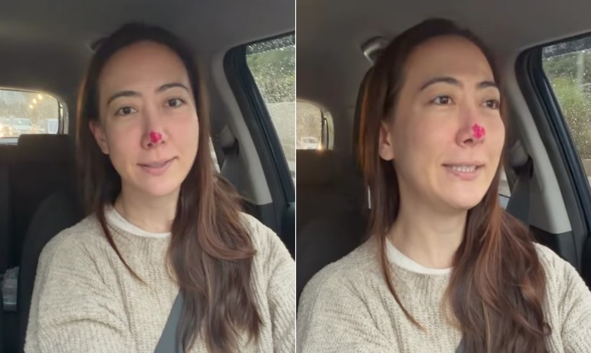 Ju Massaoka explica nariz vermelho durante tratamento após descobrir PMMA injetado sem consentimento: 'Adesivos'