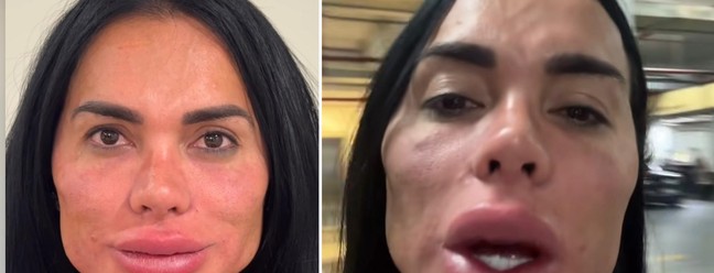 Kamila Simioni mostra rosto após harmonização facial: 'Toda inchada' — Foto: Instagram