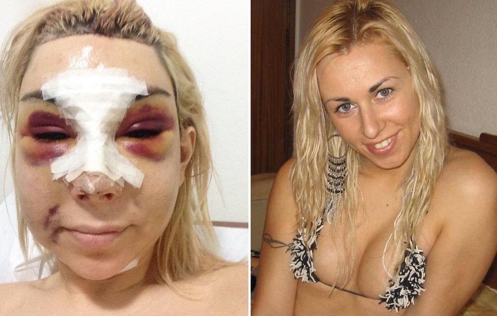 Cantora trans portuguesa Patrícia Ribeiro se arrepende de silicone industrial — Foto: Arquivo pessoal