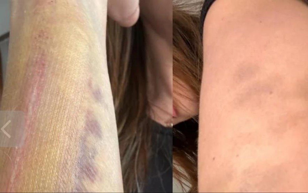 Veja fotos da agressão que Maria Melilo, campeã do 'BBB 11', teria sofrido do namorado — Foto: Reprodução