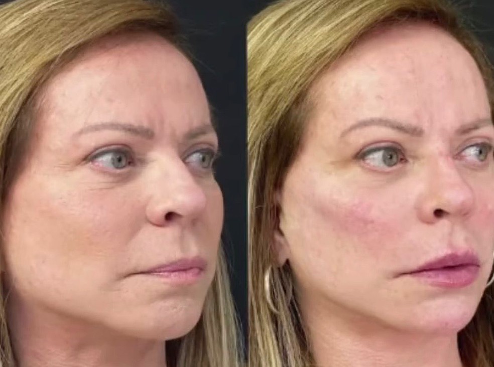 Chistina Rocha passou recentemente por uma harmonização facial — Foto: Reprodução/Instagram