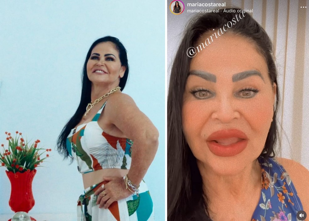 Mãe do sertanejo Eduardo Costa antes e depois da harmonização — Foto: Instagram