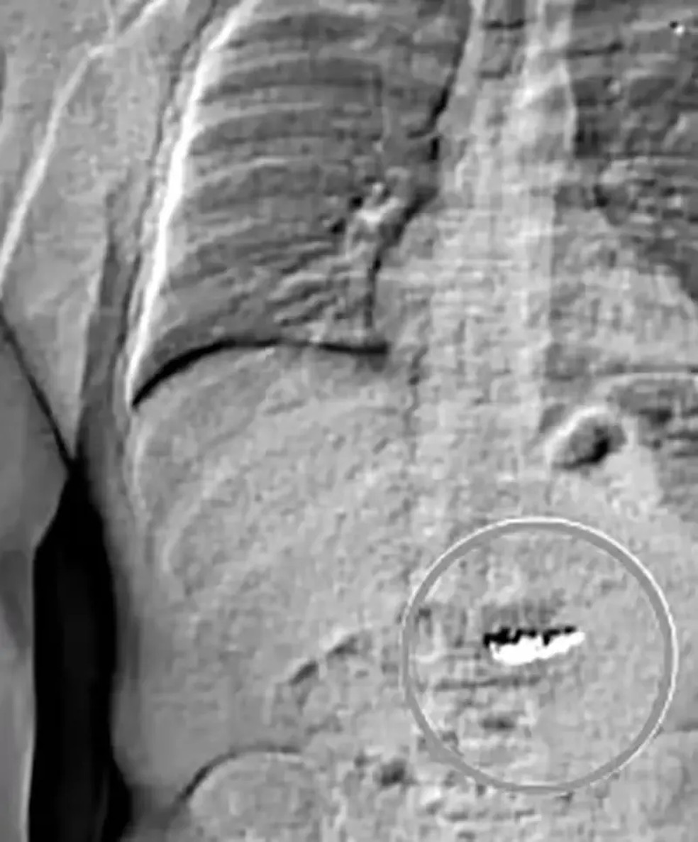 Brincos aparecem em tomografia feita de corpo de Jaythan — Foto: Orlando Police Deartment