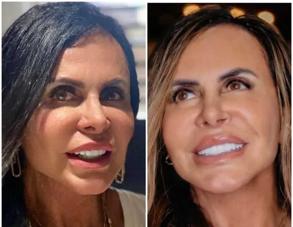Gretchen antes e depois da cobertura das olheiras — Foto: Reprodução/Instagram