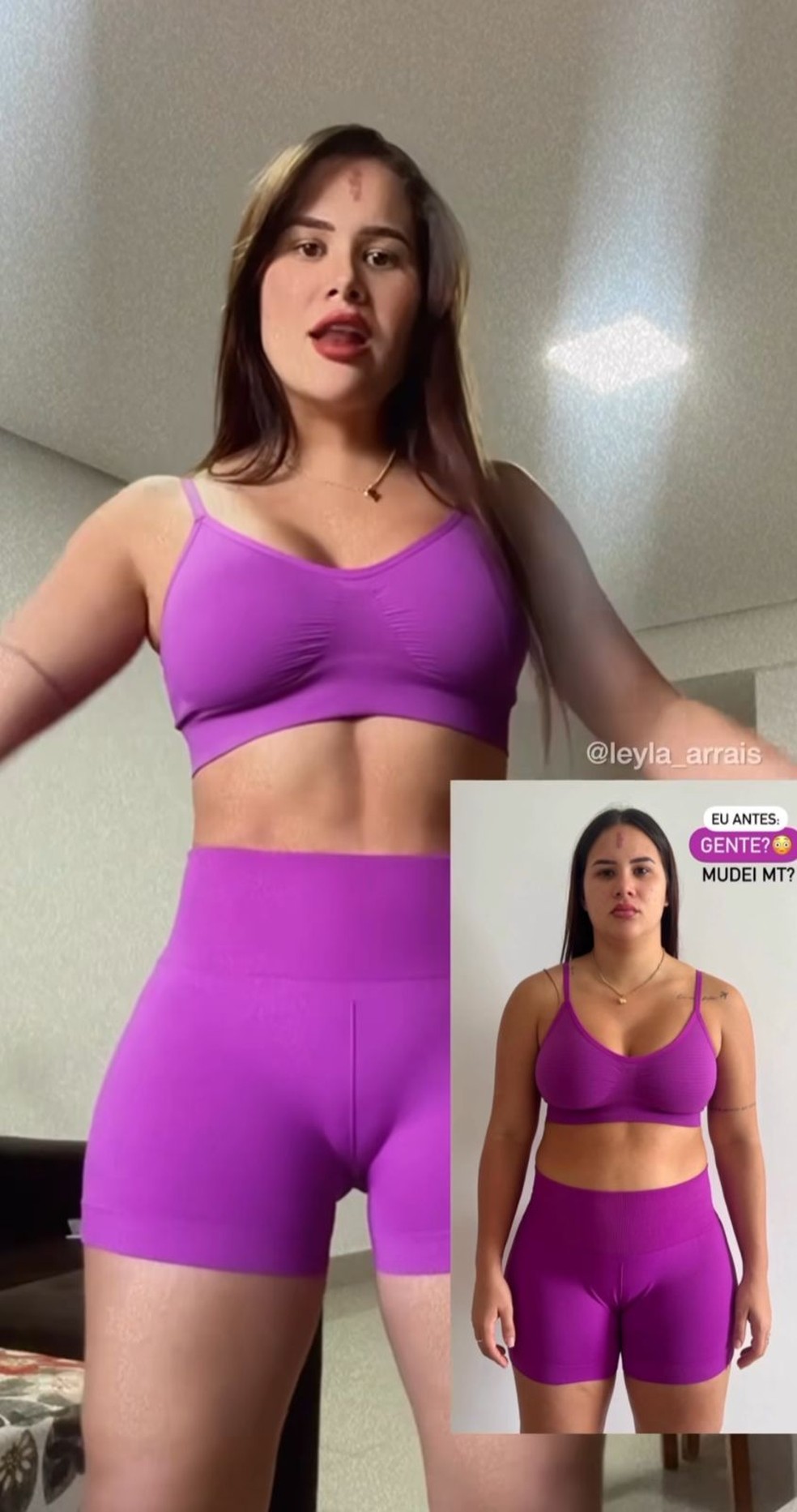 Influenciadora cria polêmica ao mostrar resultado de cirurgia íntima — Foto: Instagram