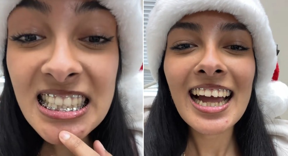 Jovem sofreu duas fraturas no maxilar ao morder doce 'quebra-queixo' — Foto: Reprodução/TikTok