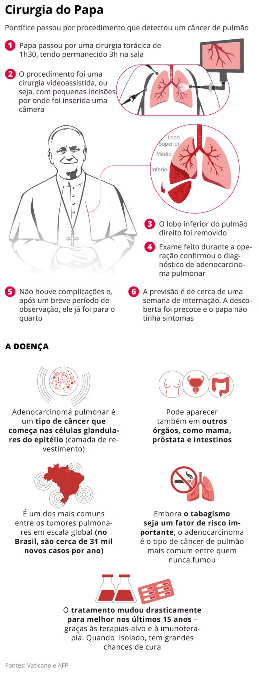Infográfico detalha o procedimento de remoção do tumor no pulmão do Papa Leão XIV e explica as características e o tratamento do adenocarcinoma pulmonar. — Foto: Editoria de Arte/O Globo