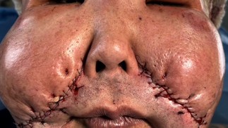 Juju do Pix passará por nova cirurgia para retirar óleo mineral do rosto — Foto: Reprodução e Instagram