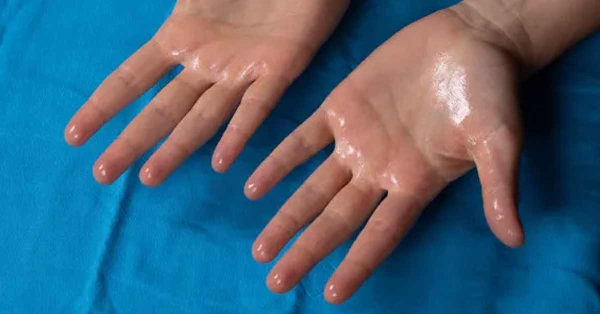 Suor Excessivo: Quando o Corpo Suou Demais — e a Vida Começa a Sentir