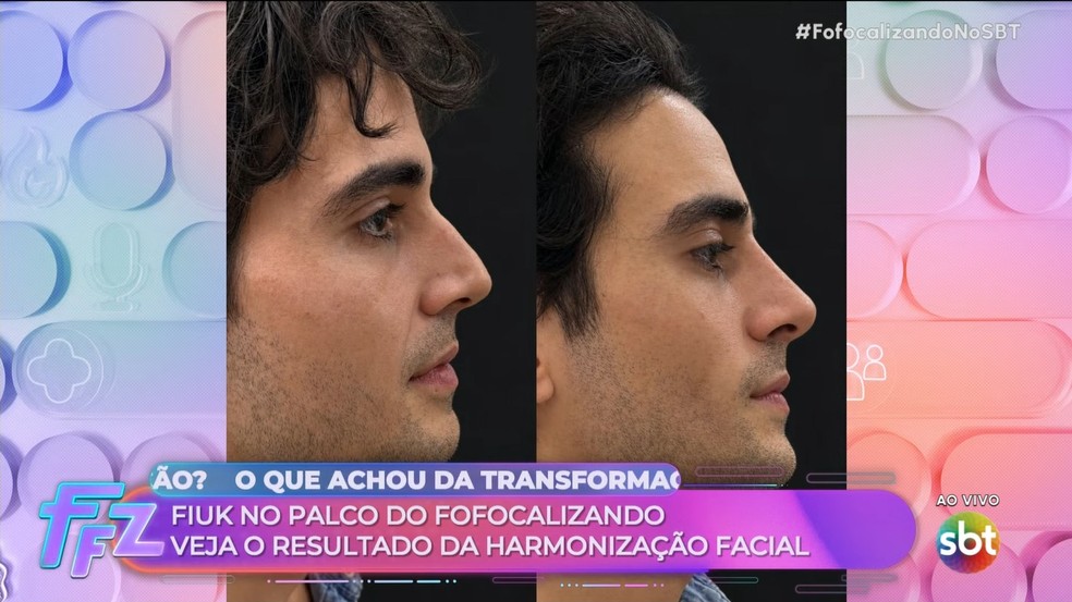 Fiuk passa por harmonização facial: antes e depois — Foto: divulgação/ sbt