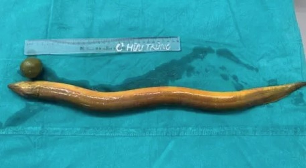 M&eacute;dicos fizeram cirurgia para retirar enguia viva de 60cm e lim&atilde;o do corpo de paciente no Vietn&atilde; &mdash; Foto: Reprodu&ccedil;&atilde;o/Viet Duc Hospital
