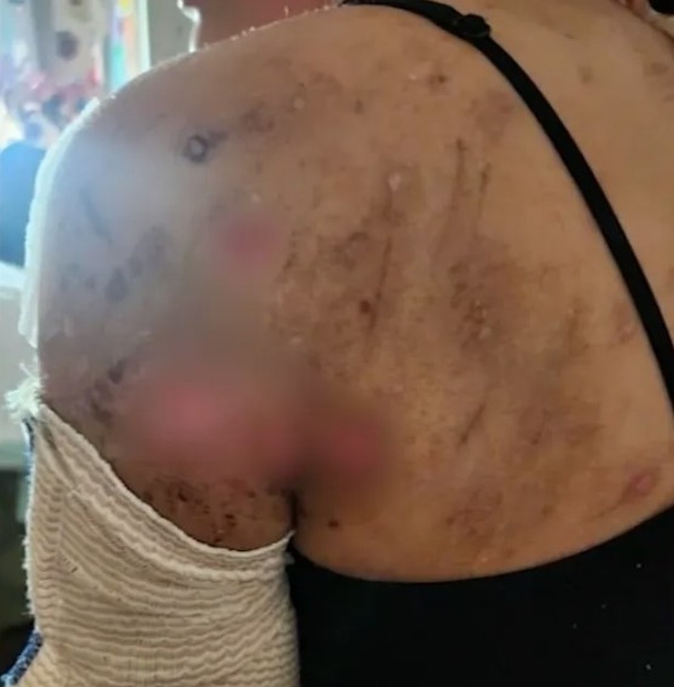 Tracy Hurtado depois de ser atacada por dez c&atilde;es na Calif&oacute;rnia &mdash; Foto: Reprodu&ccedil;&atilde;o
