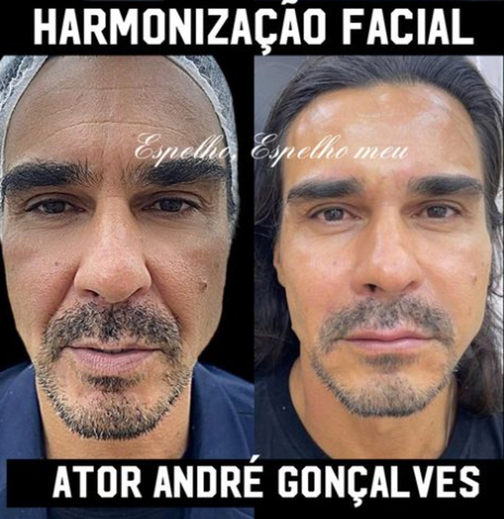 André Gonçalves faz harmonização facial — Foto: Reprodução/Instagram